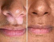 ترمیم ویتیلیگو پیسی برص